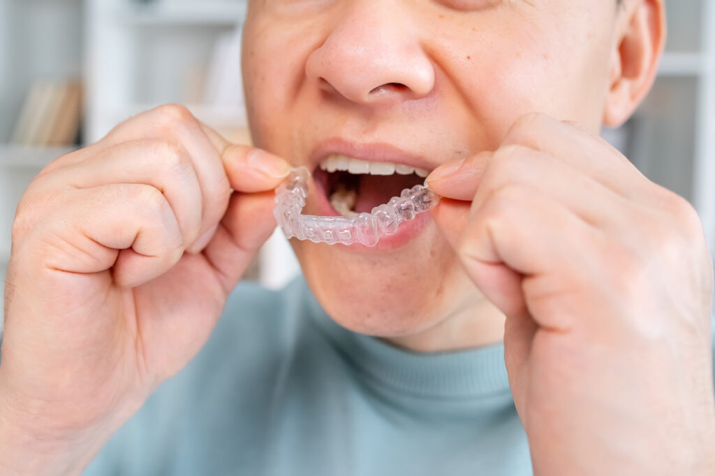 Closeup of oral guard