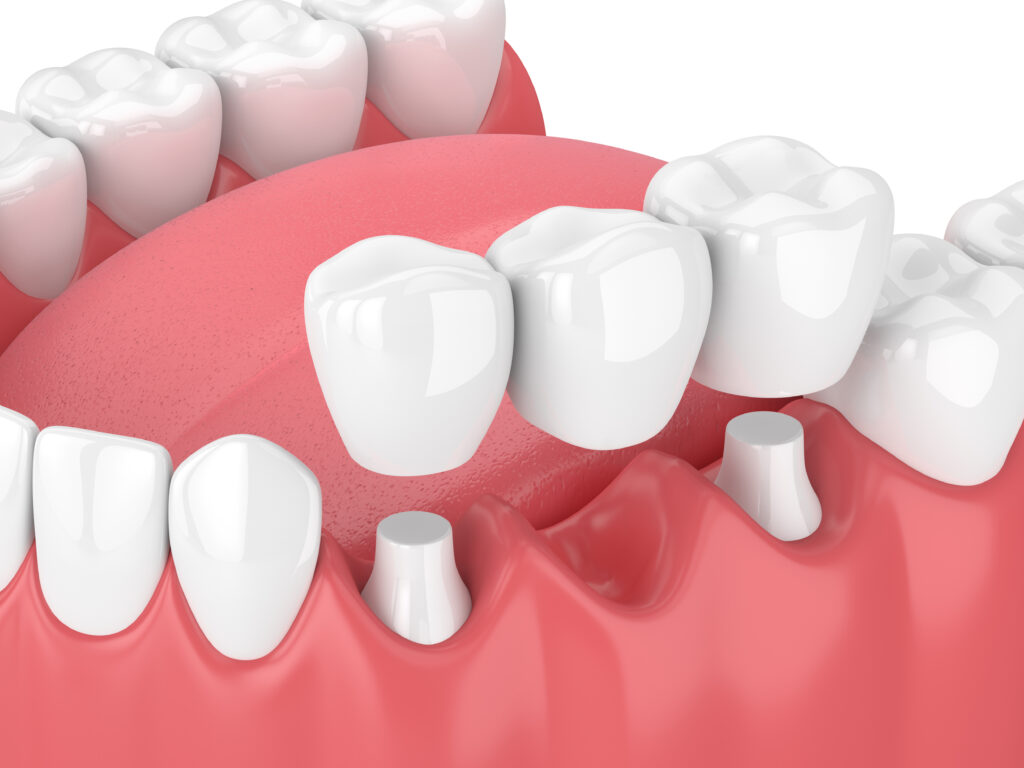 ankeny dental bridge