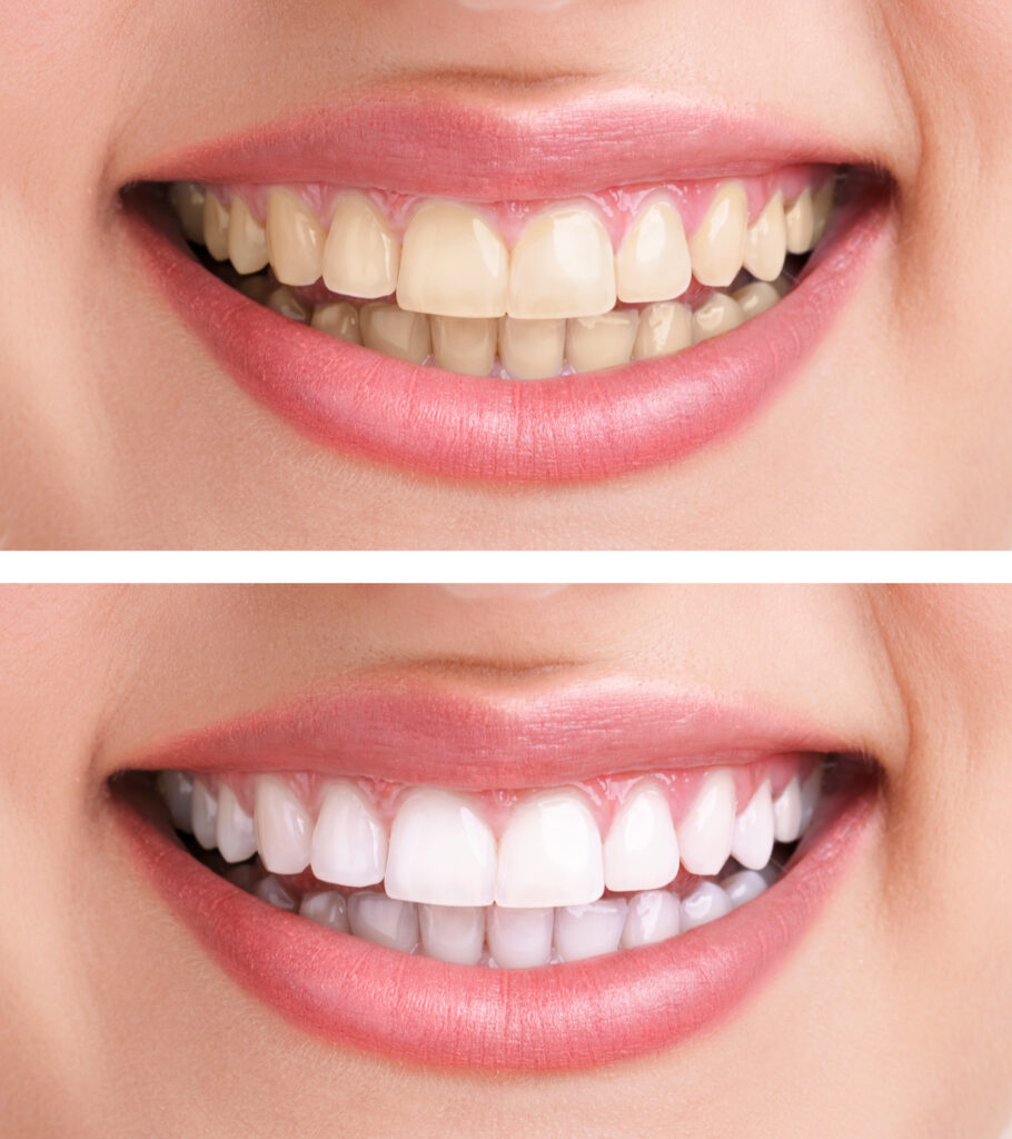 ankeny teeth stains