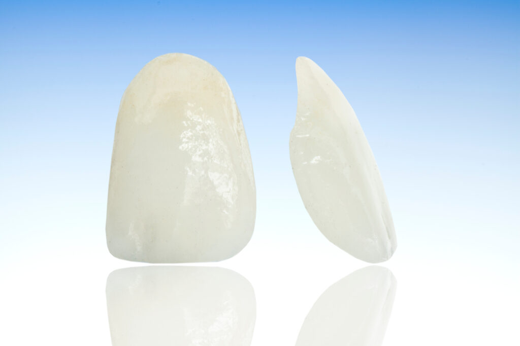 ankeny veneers