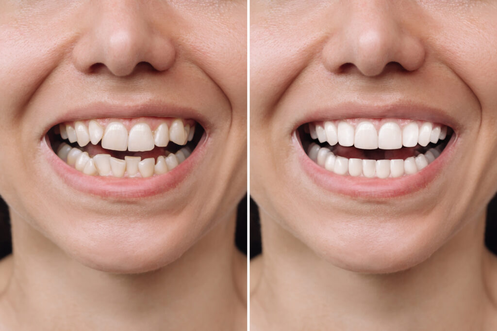 veneer smile