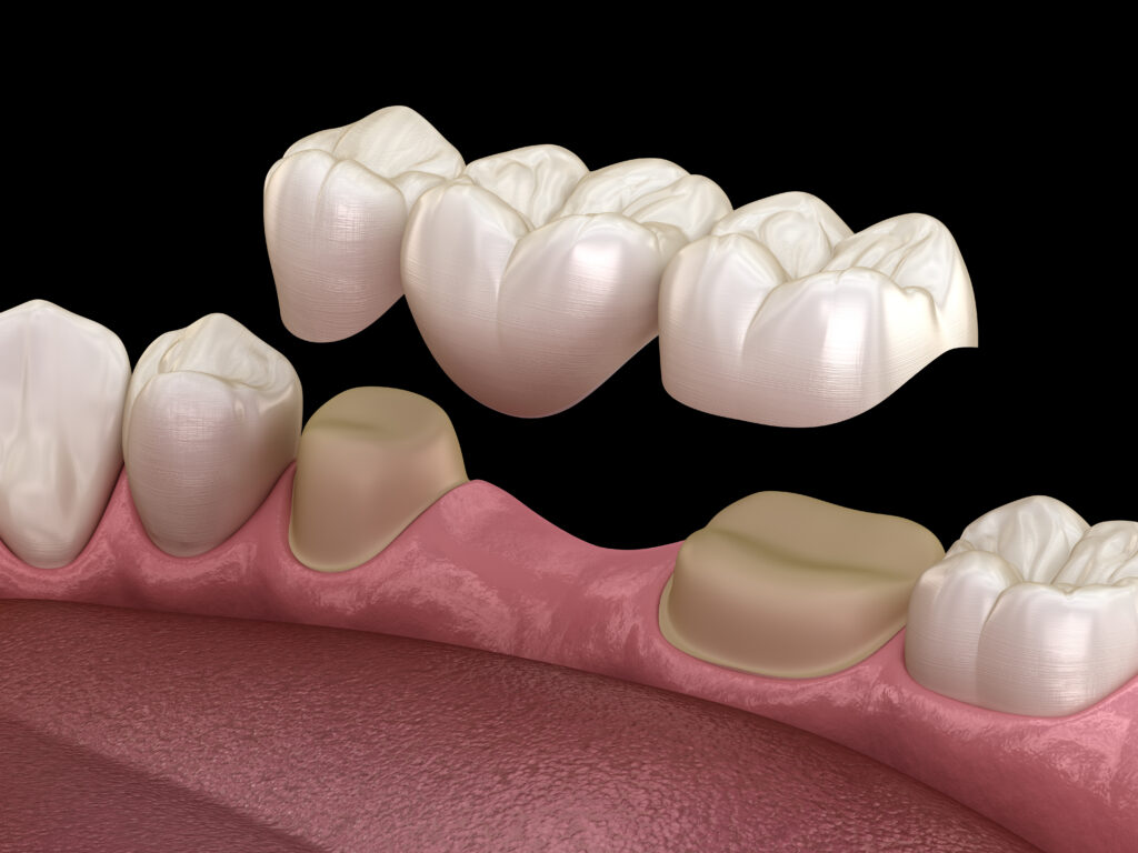 Dental bridge of 3 teeth over molar and premolar