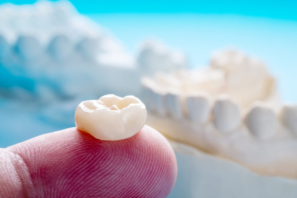 ankeny dental crowns