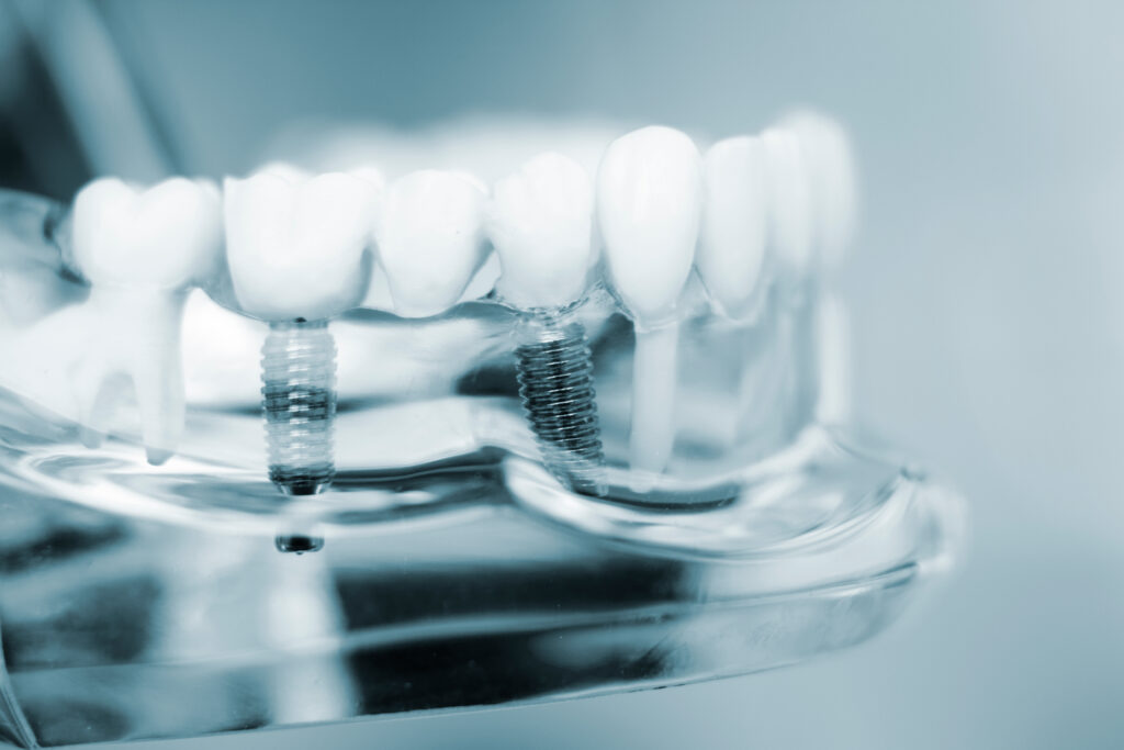 ankeny dental implants