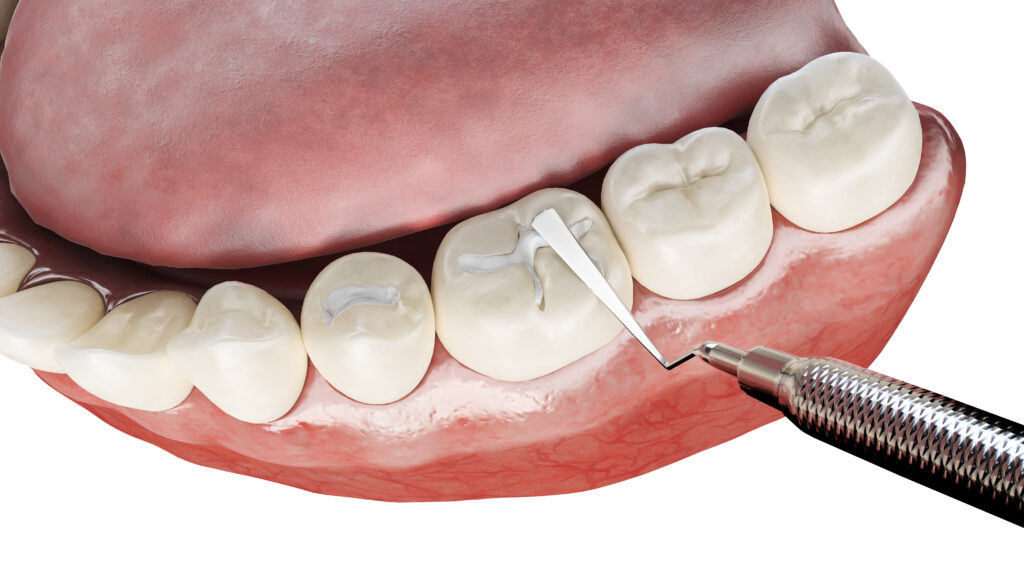 Ankeny, IA, Composite Resin