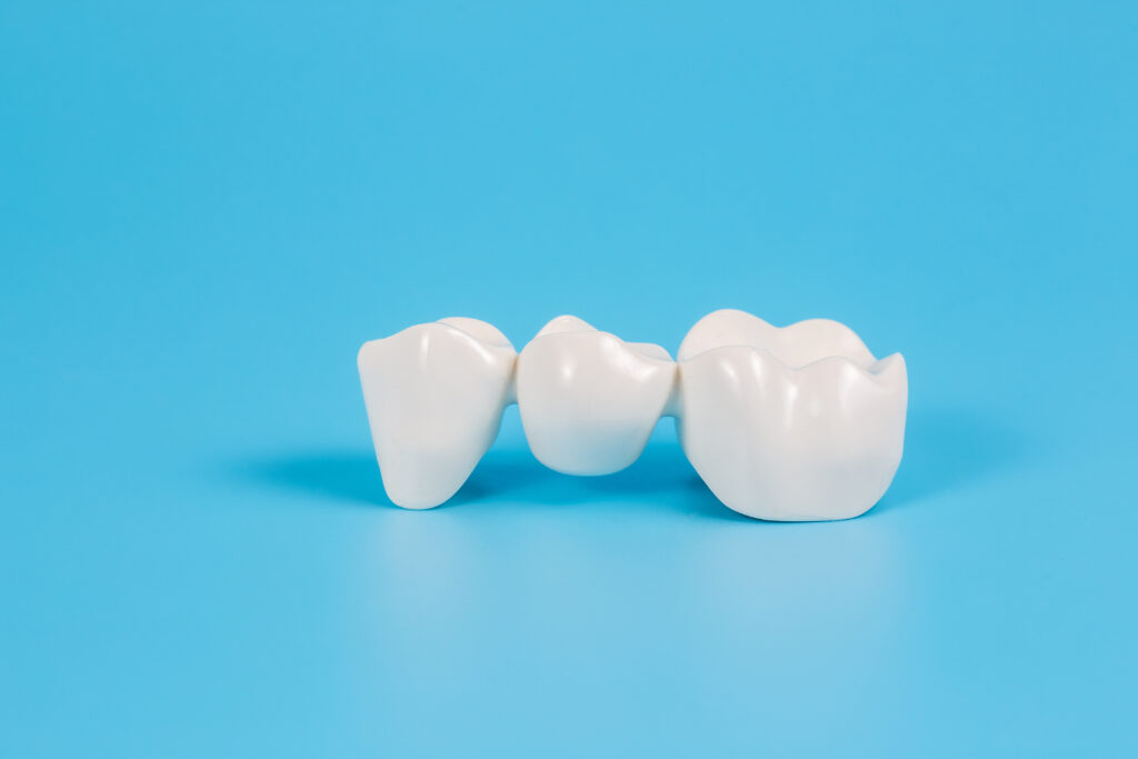 Dental Impressions of Ankeny, IA, offers restorations like bridges, crowns, and implants