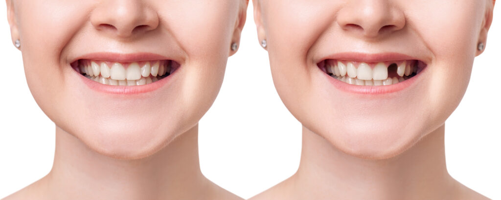 Ankeny, IA dentist offers implants