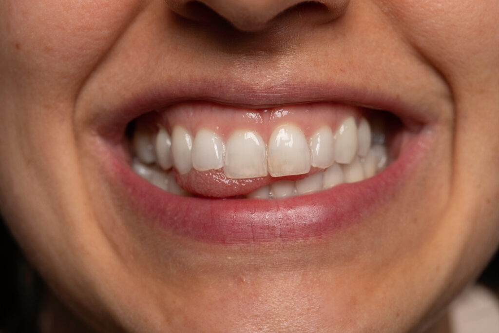 Ankeny , IA dentist offers periodontal cleanings