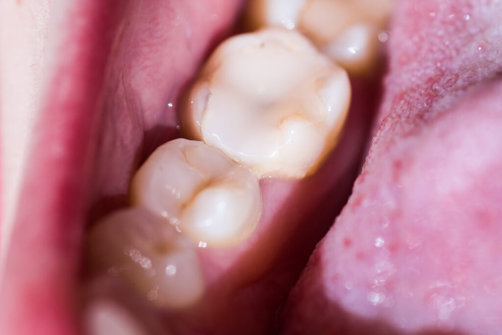 Ankeny, IA, dentist offers tooth colored fillings