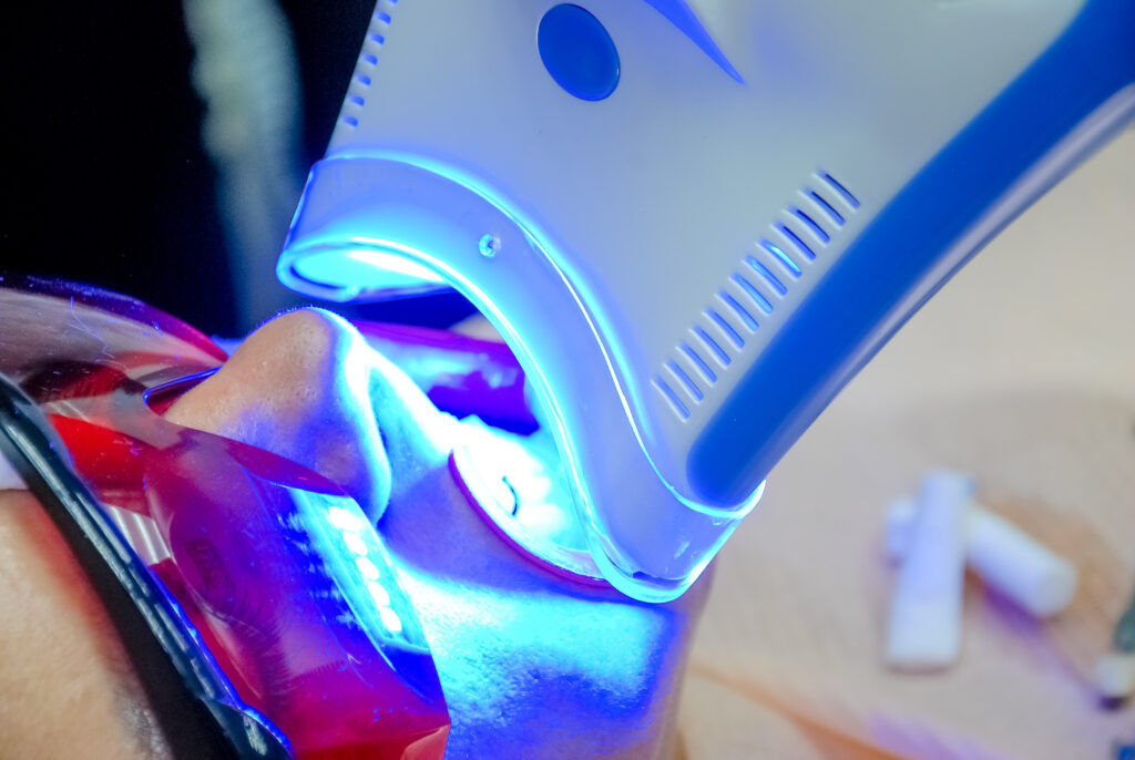 ankeny teeth whitening