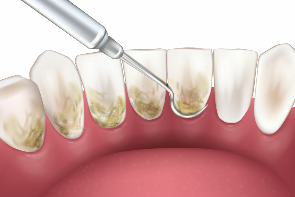 ankeny periodontal cleaning