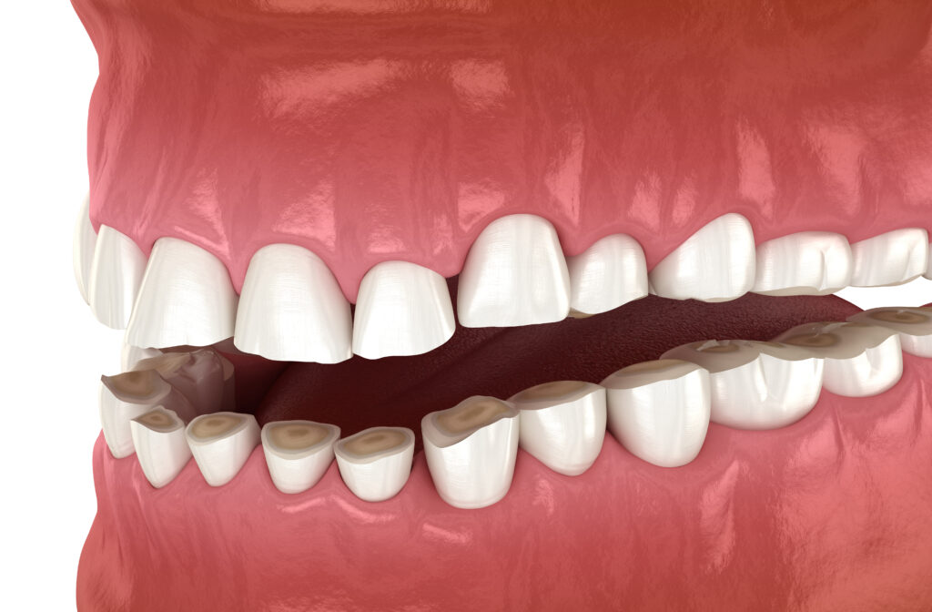 ankeny bruxism