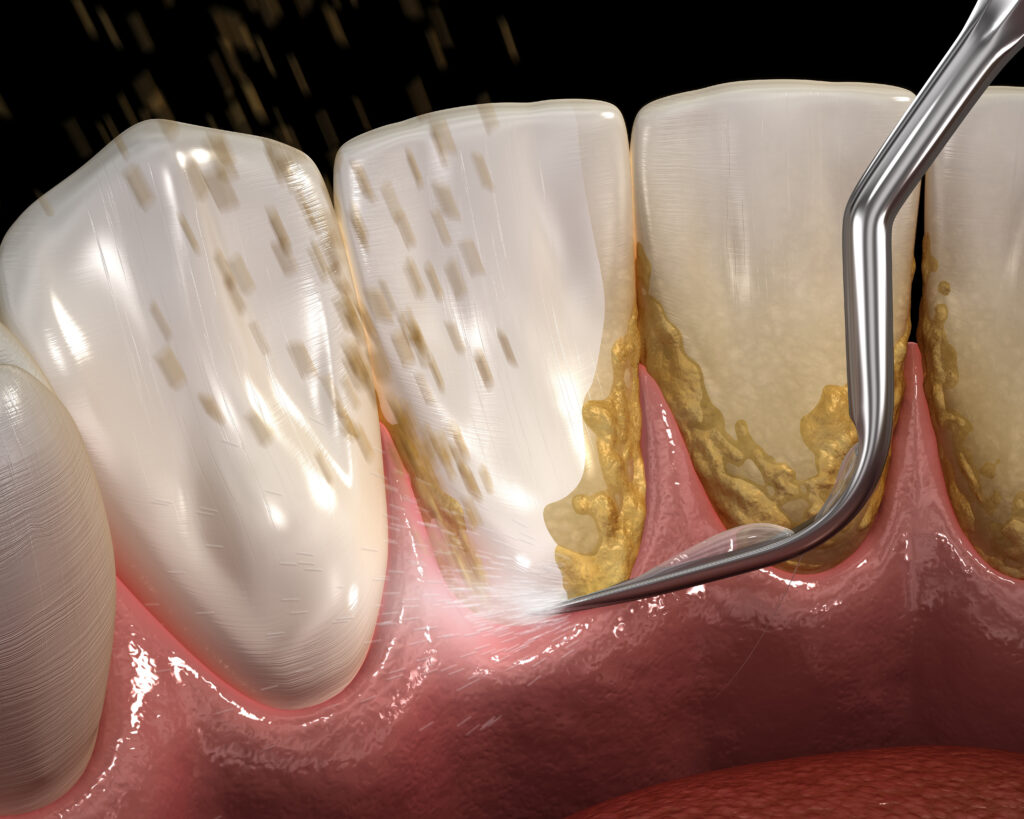 ankeny dental cleaning