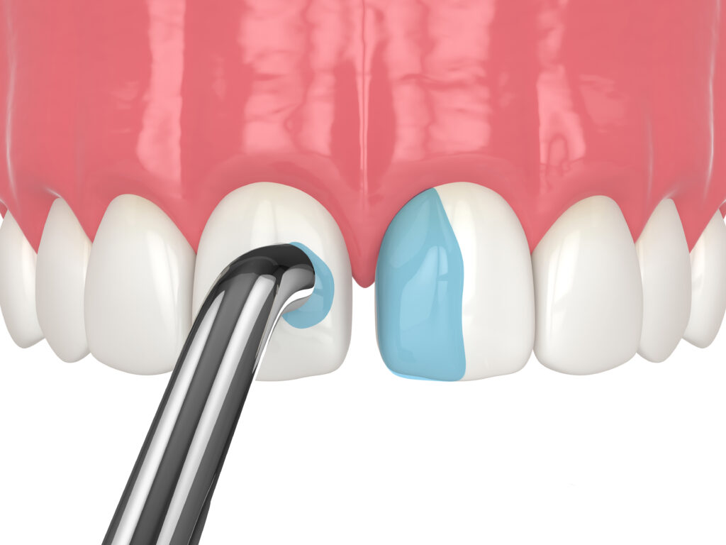 ankeny dental bonding
