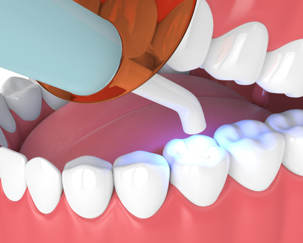 ankeny dental fillings