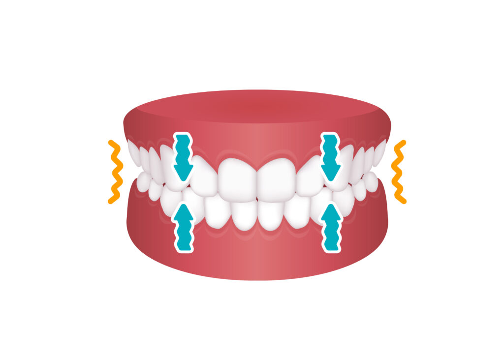 ankeny bruxism treatment