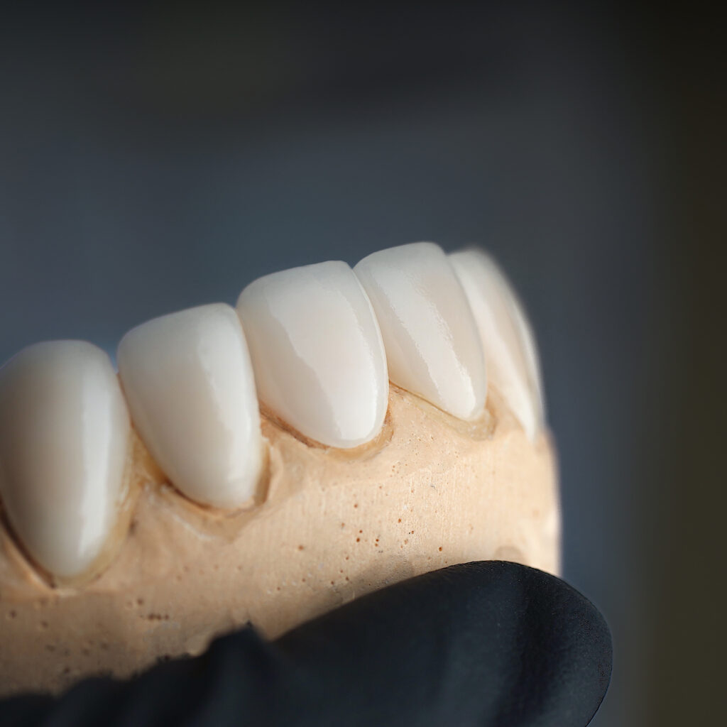 ankeny veneers