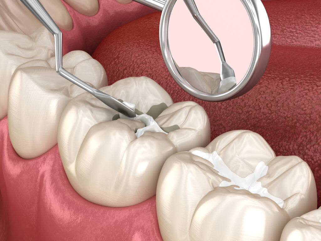 ankeny dental fillings