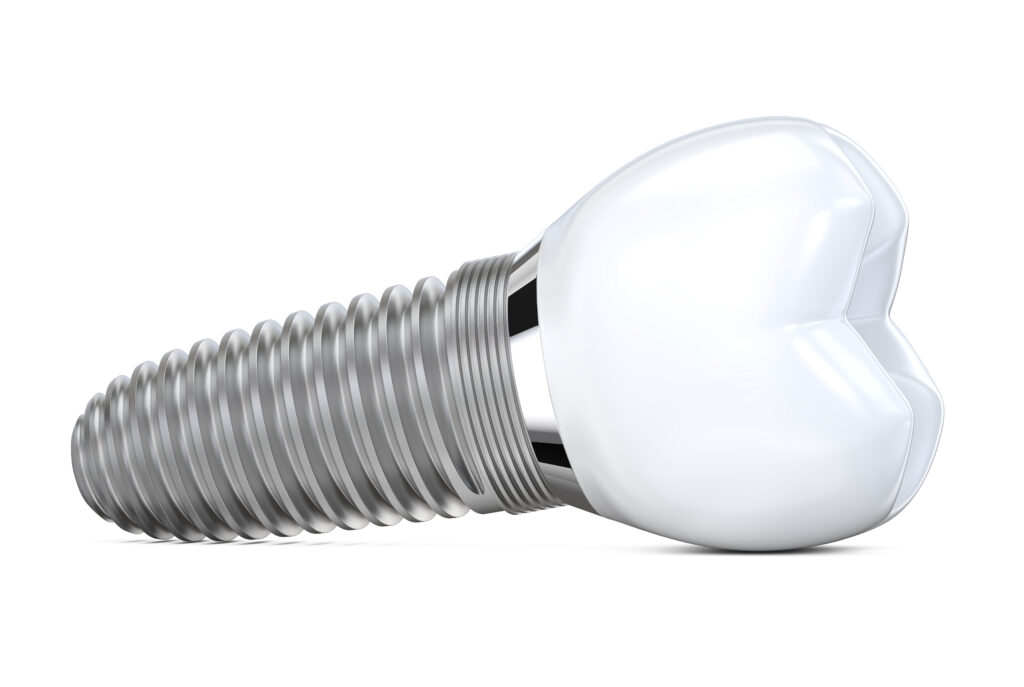 ankeny dental implant