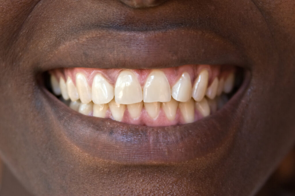 ankeny healthy gums